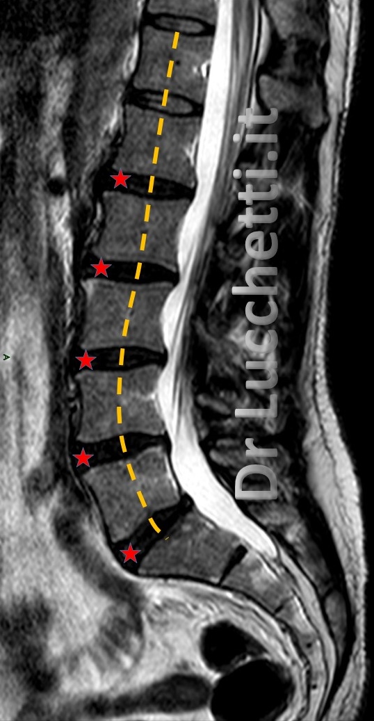 modificari degenerative disco vertebrale